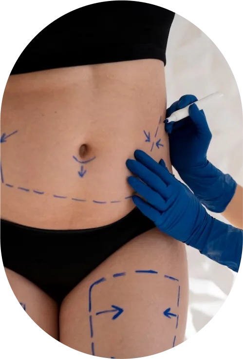CoolSculpting Elite
