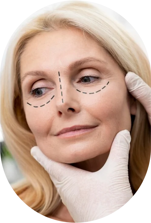Facelift