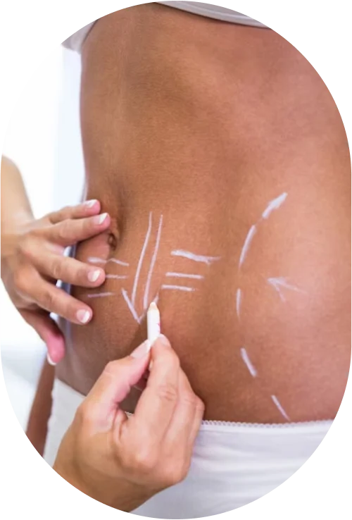 Liposuction