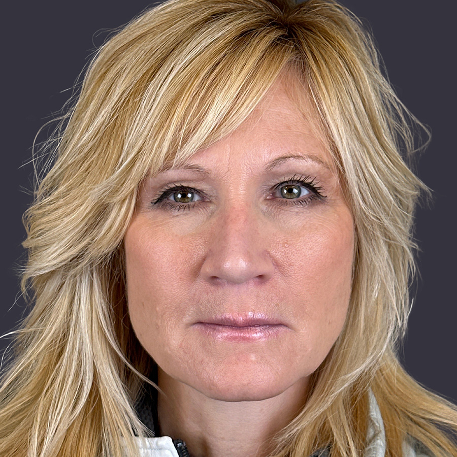 Case--1747 | After Rhinoplasty