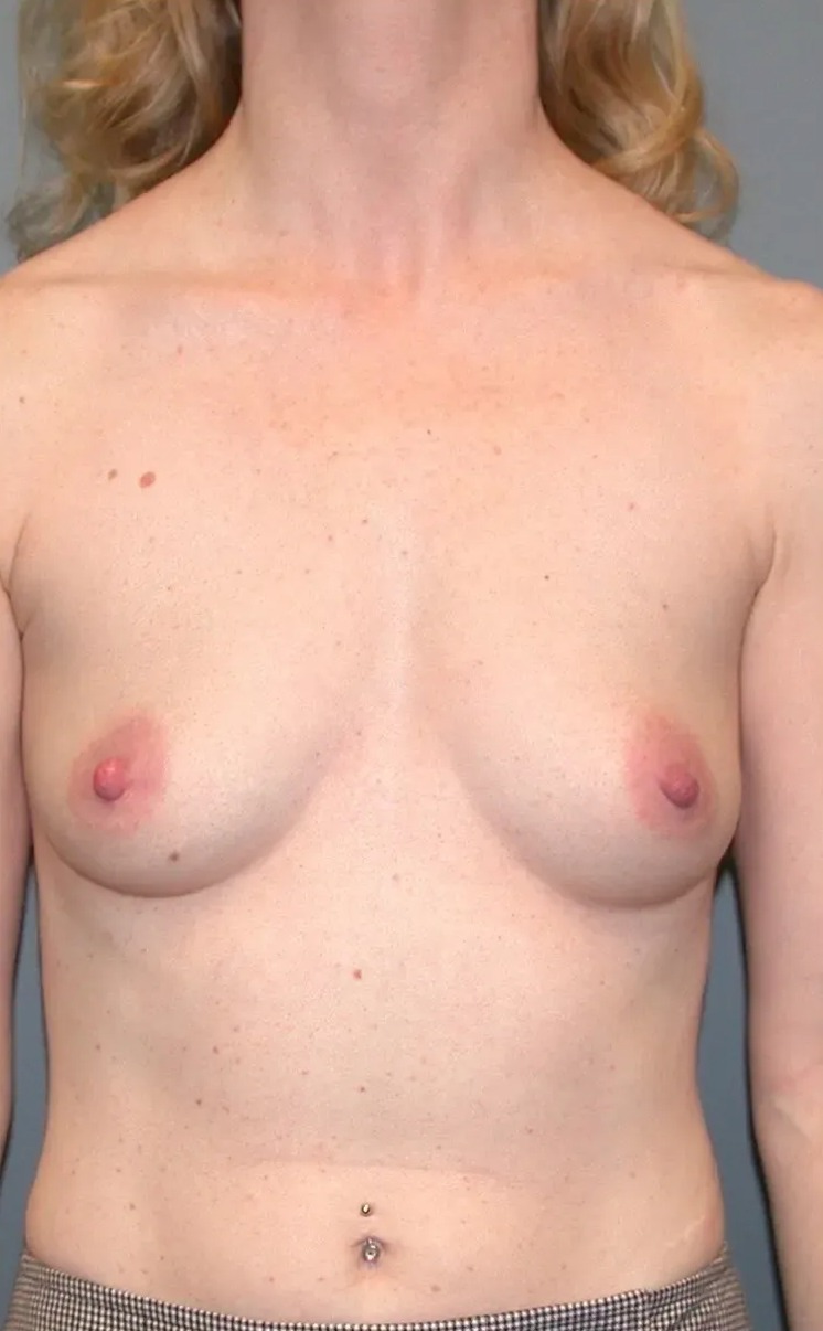 Case--3289 | Before Breast Augmentation