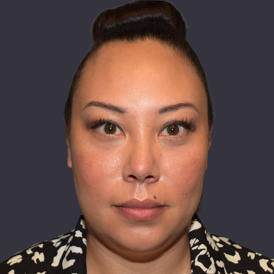 Case--1881 | After Blepharoplasty