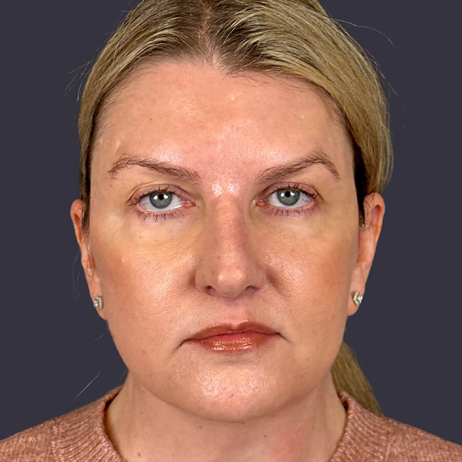 Case--8066 | After Neck Lift