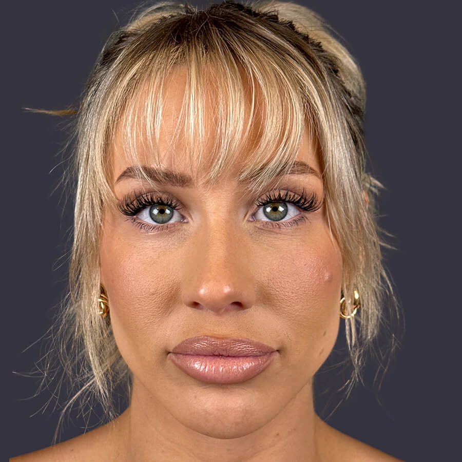 Case--6101 | After Blepharoplasty