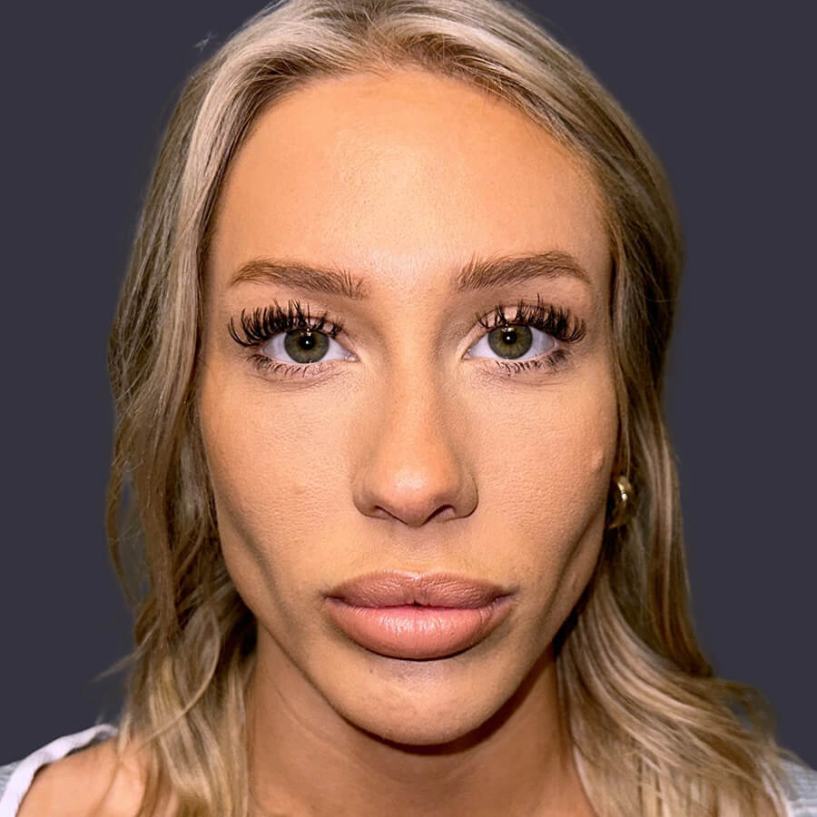 Case--6101 | Before Blepharoplasty