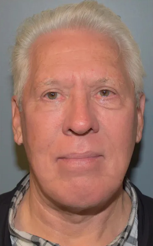 Case--3888 | After Facial Rejuvenation