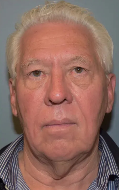 Case--3888 | Before Facial Rejuvenation