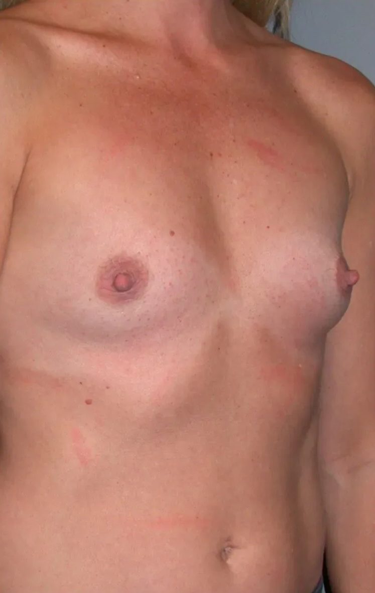 Case--3947 | Before Breast Augmentation