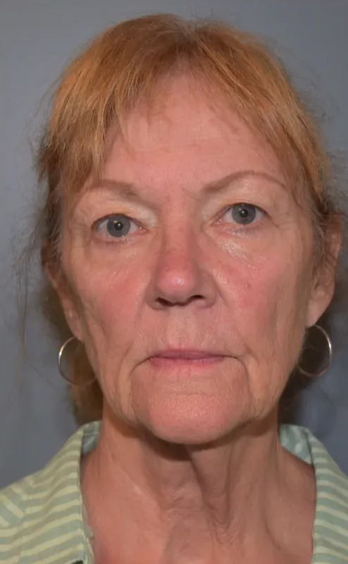 Case--7935 | Before Facial Rejuvenation